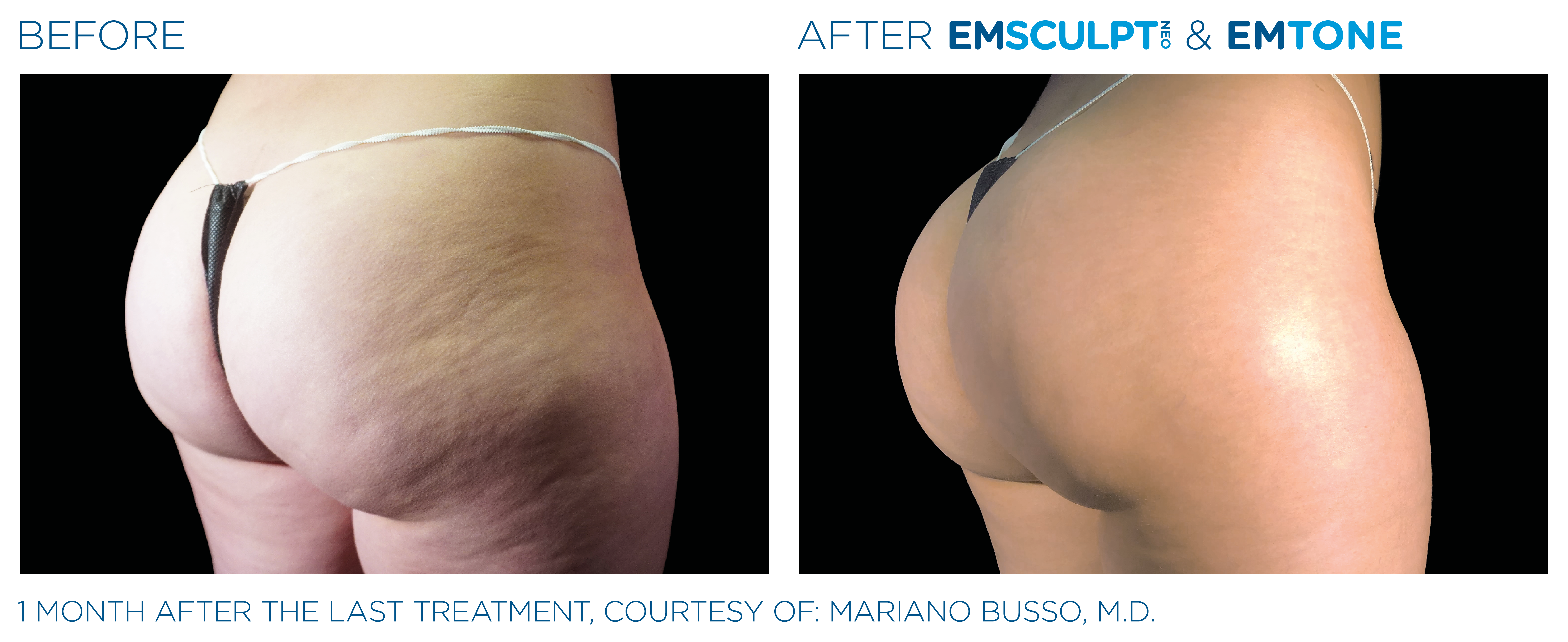 Emsculpt_Neo-Emtone_PIC_Ba-card-female-buttock-008_ENUS100