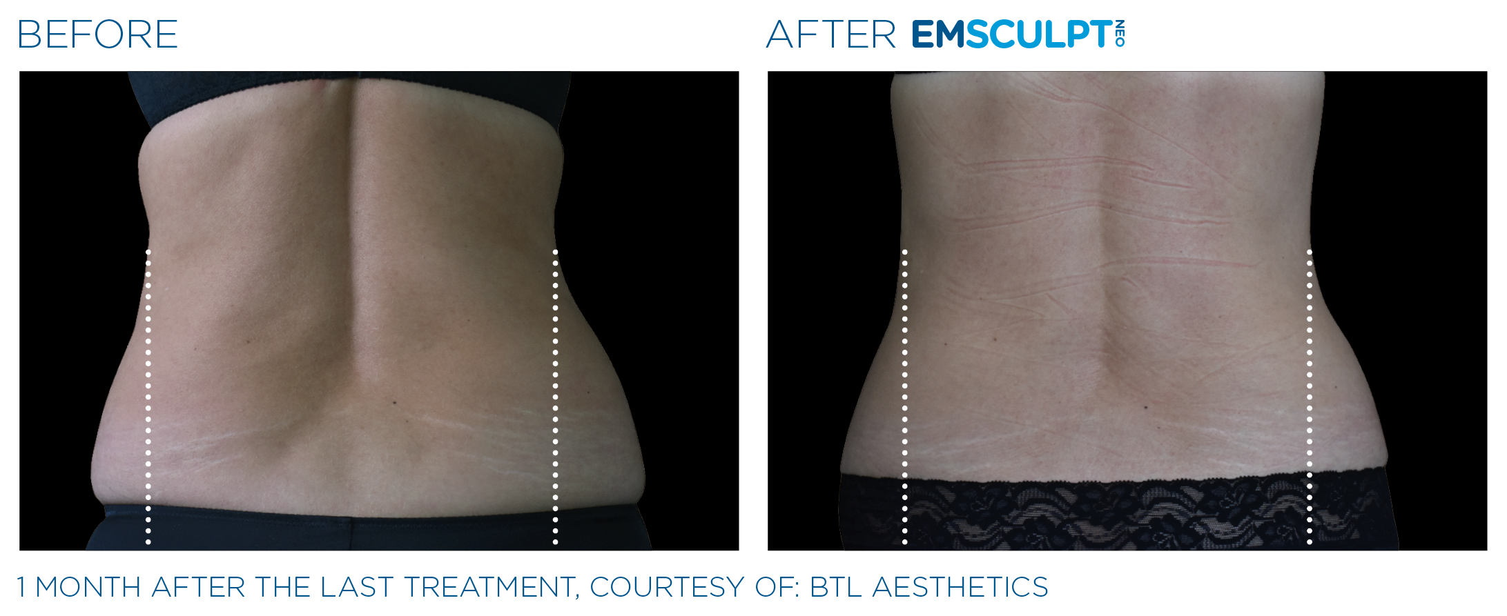 Emsculpt_Neo_PIC_Ba-card-female-lateral-abdomen-117_ENUS100